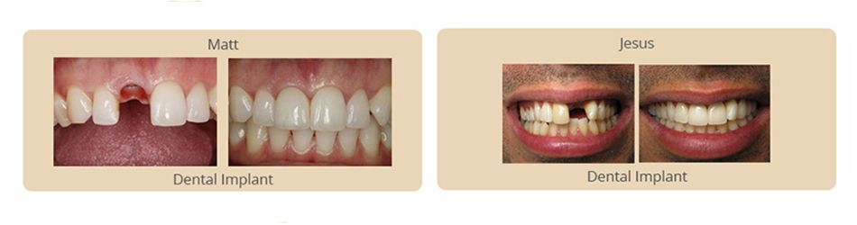Expectations of Dental Implants Crystal Lake
