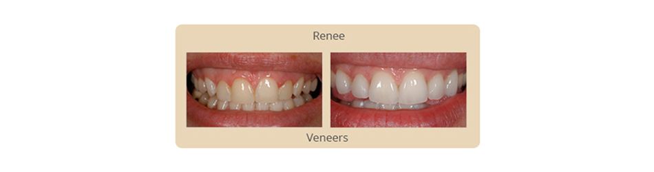 Porcelain Veneers Algonquin