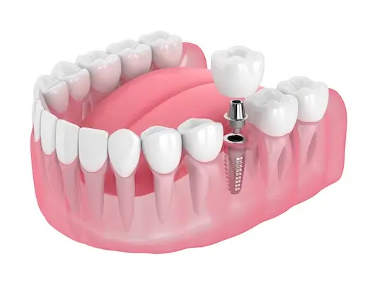 Dental Implant Surgeon Algonquin | Advanced Dental & Implant Care | Dental Implant Specialist